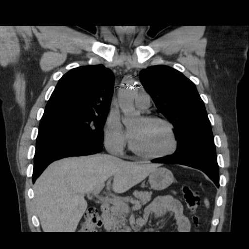 File:Aortic arch stent (Radiopaedia 30030-30595 Coronal non-contrast 4).jpg