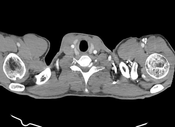 File:Aortic coarctation with aneurysm (Radiopaedia 74818-85828 A 192).jpg