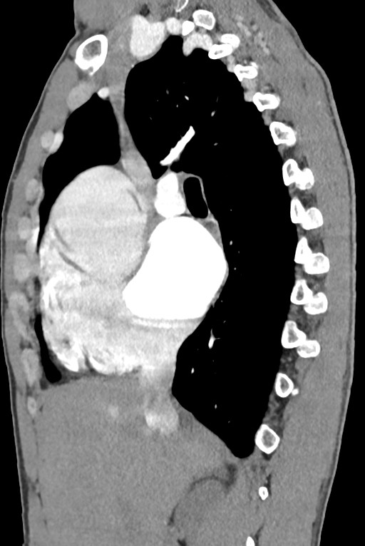 Aortic coarctation with aneurysm (Radiopaedia 74818-85828 B 66).jpg