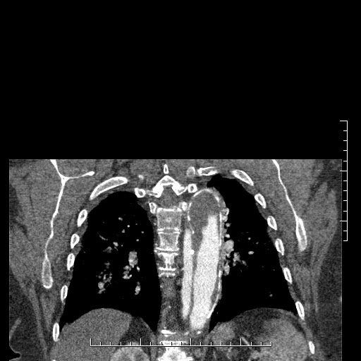 Aortic dissection- Stanford A (Radiopaedia 35729-37268 E 3).jpg
