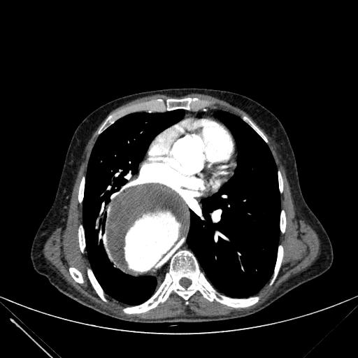 Aortic dissection (Radiopaedia 27466-27665 C+ arterial phase 147).jpg