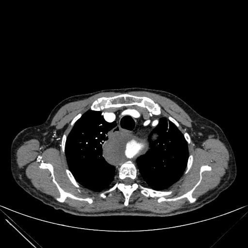 Aortic dissection (Radiopaedia 27466-27665 C+ arterial phase 16).jpg