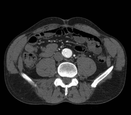 Aortic dissection - Stanford type B (Radiopaedia 73648-84437 A 192).jpg
