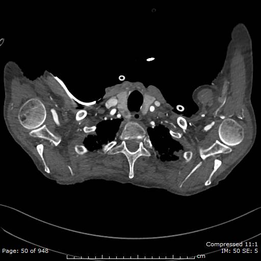 Aortic dissection with extension into aortic arch branches (Radiopaedia 64402-73204 B 50).jpg
