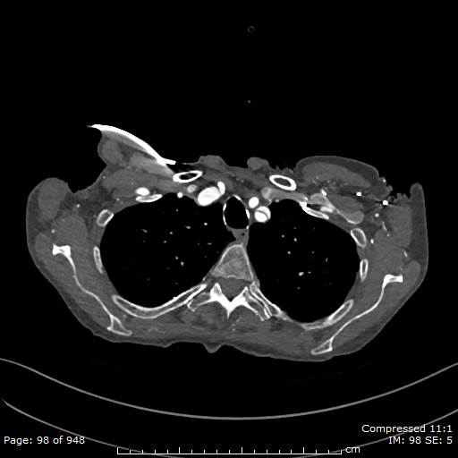 File:Aortic dissection with extension into aortic arch branches (Radiopaedia 64402-73204 B 98).jpg