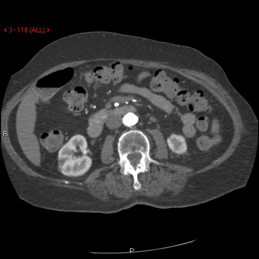 Aortic intramural hematoma (Radiopaedia 27746-28001 A 118).jpg