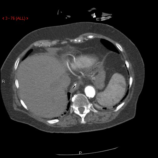 File:Aortic intramural hematoma (Radiopaedia 27746-28001 A 76).jpg