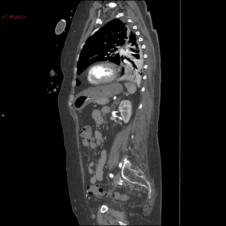 Aortic intramural hematoma (Radiopaedia 27746-28001 C 49).jpg