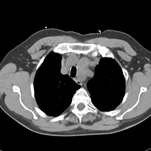 Aortic intramural hematoma (Radiopaedia 31139-31838 Axial non-contrast 12).jpg