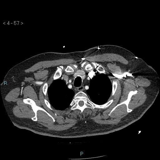 File:Aortic intramural hematoma (Radiopaedia 48463-53380 B 27).jpg