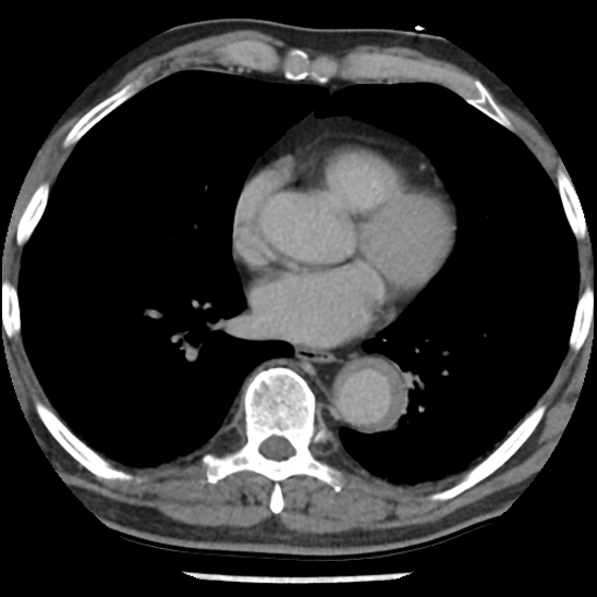 Aortic intramural hematoma (type B) (Radiopaedia 79323-92387 Axial C+ delayed 32).jpg