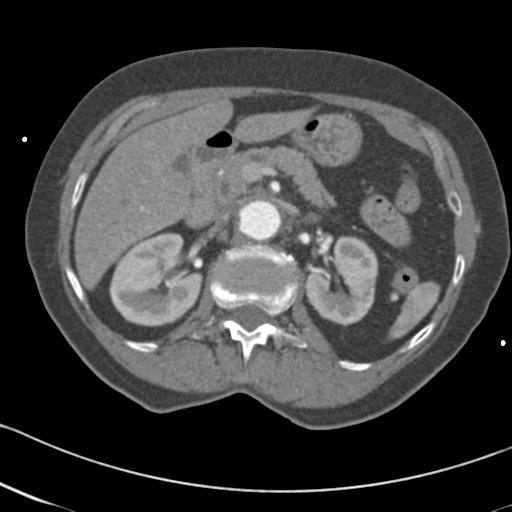 Aortic intramural hematoma from penetrating atherosclerotic ulcer (Radiopaedia 31137-31836 A 92).jpg
