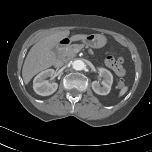 Aortic intramural hematoma from penetrating atherosclerotic ulcer (Radiopaedia 31137-31836 A 94).jpg