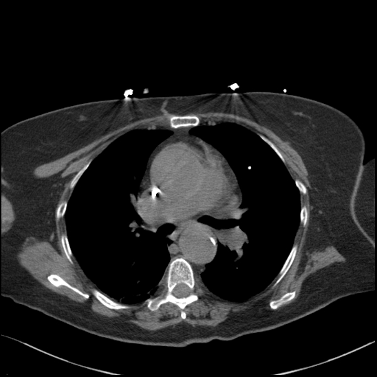 File:Aortic intramural hematoma with dissection and intramural blood pool (Radiopaedia 77373-89491 Axial non-contrast 42).jpg