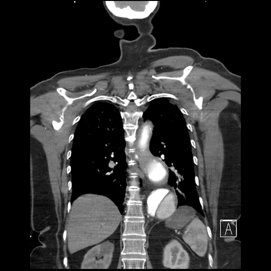 Aortic intramural hematoma with dissection and intramural blood pool (Radiopaedia 77373-89491 C 47).jpg