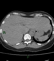 Aortic valve endocarditis (Radiopaedia 87209-103485 Axial non-contrast 88).jpg