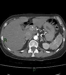 Aortic valve endocarditis (Radiopaedia 87209-103485 C 98).jpg