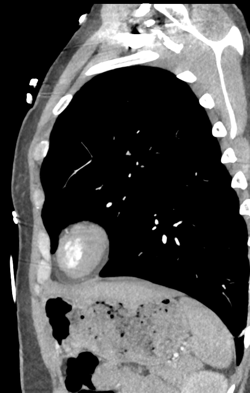 Aortic valve non-coronary cusp thrombus (Radiopaedia 55661-62189 C+ arterial phase 2).png