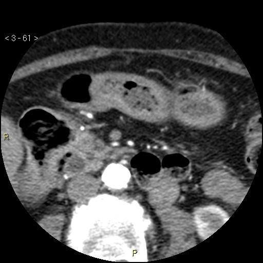 Aortoiliac occlusive disease (Radiopaedia 16828-16548 A 61).jpg