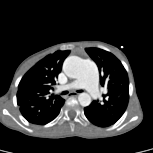 File:Aortopulmonary window, interrupted aortic arch and large PDA giving the descending aorta (Radiopaedia 35573-37074 B 34).jpg