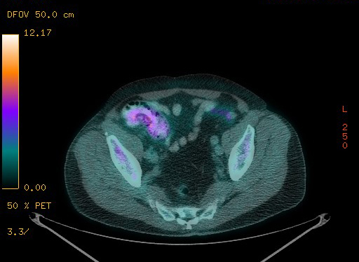 Appendiceal adenocarcinoma complicated by retroperitoneal abscess (Radiopaedia 58007-65041 Axial PET-CT 172).jpg
