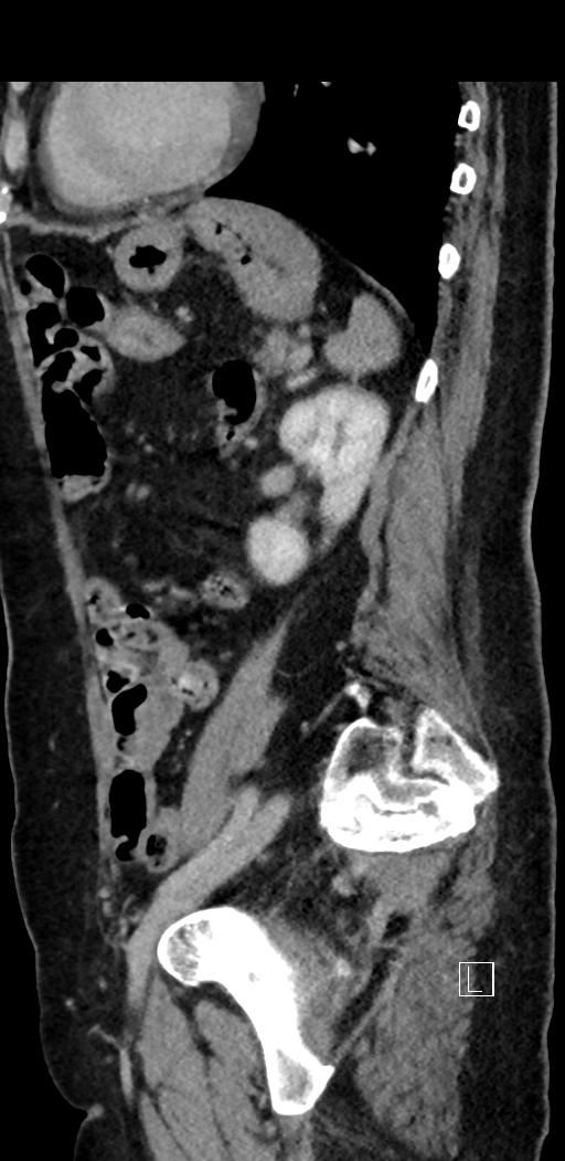 Appendiceal hemorrhage (Radiopaedia 70830-81025 Sagittal C+ delayed 75).jpg