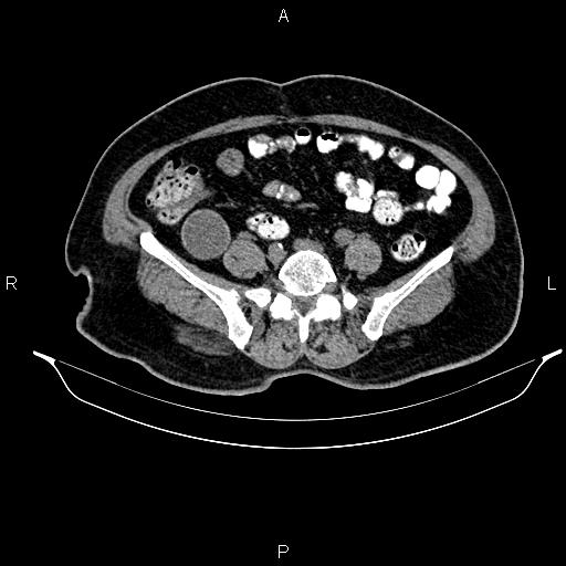 Appendiceal mucocele (Radiopaedia 82952-97298 A 71).jpg