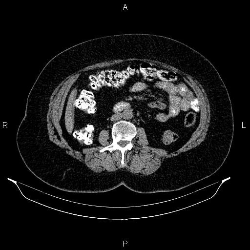 Appendiceal mucocele (Radiopaedia 86415-102460 Axial non-contrast 29).jpg