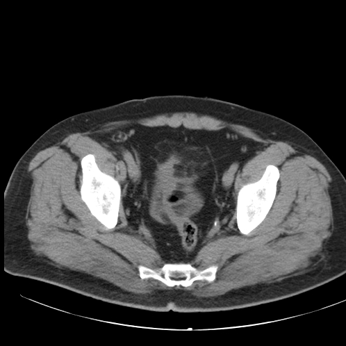 File:Appendicitis and giant appendicolith (Radiopaedia 80251-93588 Axial non-contrast 51).jpg