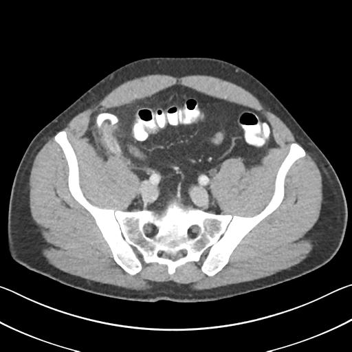 Appendicitis with cecal bar sign (Radiopaedia 31878-32830 B 61).jpg