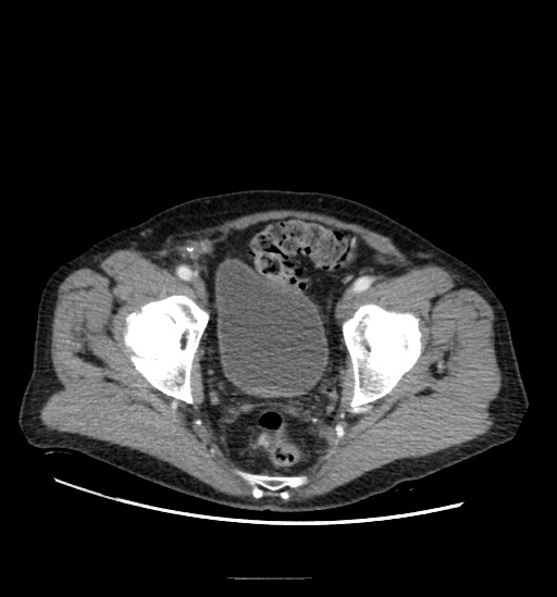 Appendicitis with localized perforation and abscess formation (Radiopaedia 49035-54130 A 78).jpg