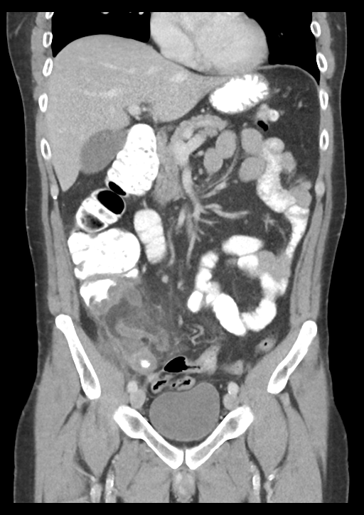 Appendicitis with thickening of the terminal ileum (Radiopaedia 42432-45550 B 24).png