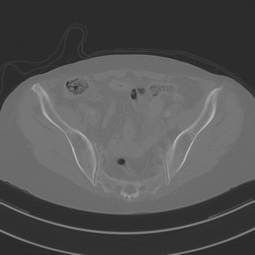 April fools' 2019- calcified peritoneal arachnoidosis (Radiopaedia 67273-76636 Axial bone window 42).png