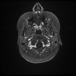 Arachnoid cyst (Radiopaedia 46791-51321 Axial T1 C+ fat sat 1).jpg