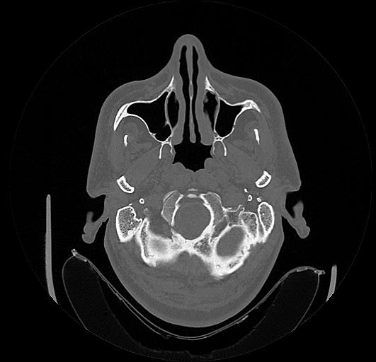 Arcuate foramen (Radiopaedia 89833-106944 Axial bone window 1).jpg