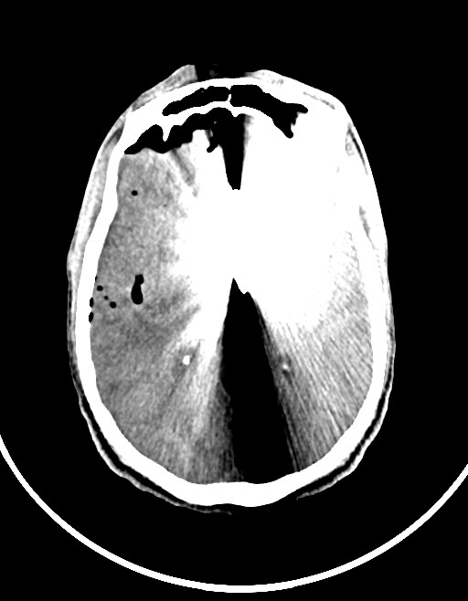 Arrow injury to the brain (Radiopaedia 72101-82607 Axial non-contrast 71).jpg