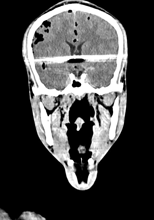 Arrow injury to the brain (Radiopaedia 72101-82607 Coronal non-contrast 36).jpg
