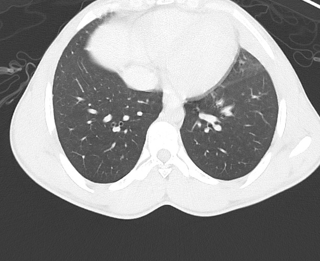File:Arrow injury to the chest (Radiopaedia 75223-86321 Axial lung window 61).jpg