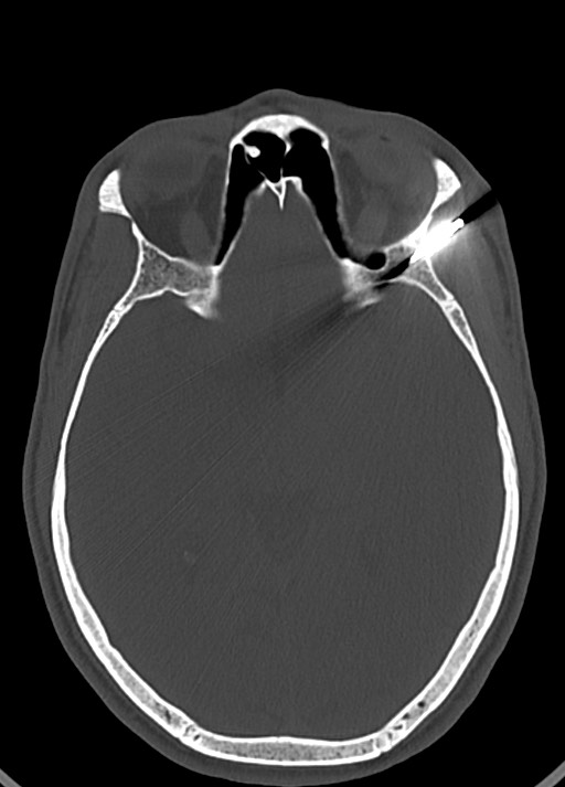 Arrow injury to the head (Radiopaedia 75266-86388 Axial bone window 69).jpg