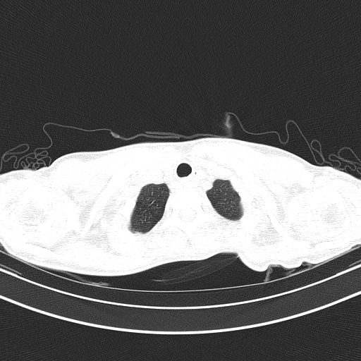 Arteria lusoria (Radiopaedia 88528-105192 Axial lung window 9).jpg