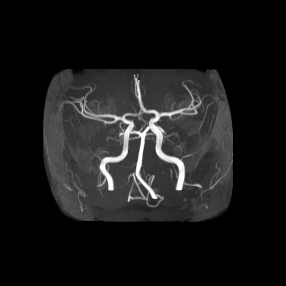 Artery of Percheron infarct (Radiopaedia 40966-43676 F 7).jpg