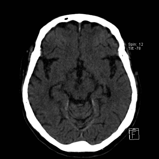 File:Artery of Percheron infarction (Radiopaedia 26307-26439 Axial non-contrast 4).jpg