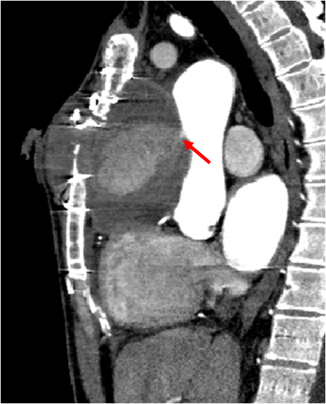 File:Ascending aortic pseudoaneurysm (Radiopaedia 28638-28911 C 1).png