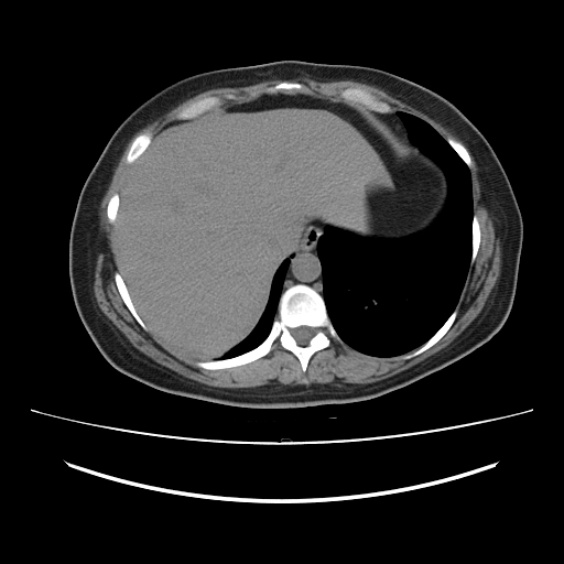 Ascending retrocecal appendicitis with liver abscesses (Radiopaedia 60066-67615 Axial non-contrast 13).jpg