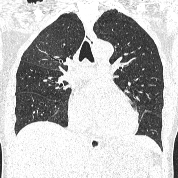 File:Aspergilloma (Radiopaedia 26223-26347 Coronal lung window 25).jpg