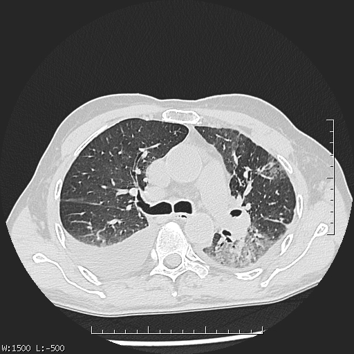 Aspergilloma (Radiopaedia 75184-86270 Axial lung window 20).jpg