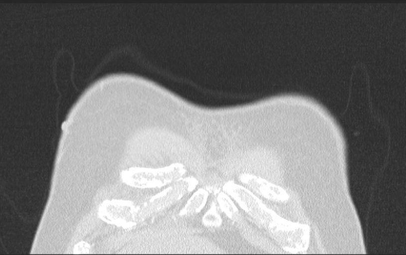 Aspirated tooth (Radiopaedia 28584-28844 Axial lung window 20).jpg