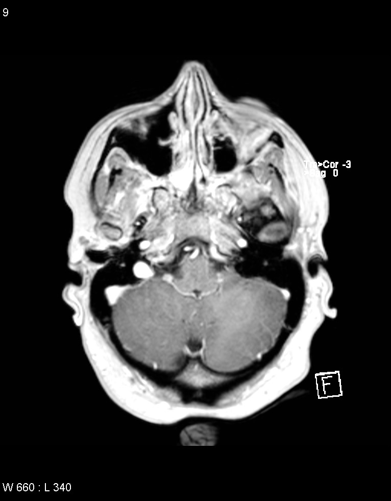 Astroblastoma (Radiopaedia 39792-42218 Axial T1 C+ 8).jpg