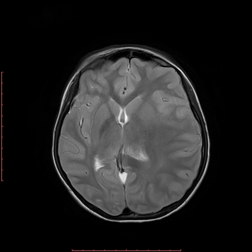 File:Astroblastoma (Radiopaedia 74287-85162 Axial T2 11).jpg