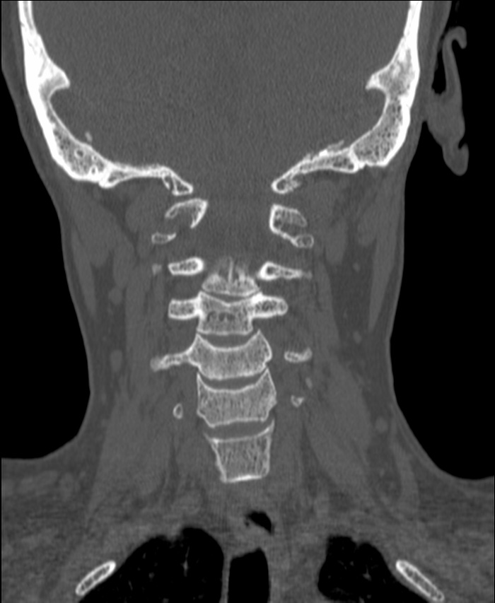 Atlanto-occipital assimilation with basilar invagination (Radiopaedia 70122-80188 Coronal bone window 113).jpg